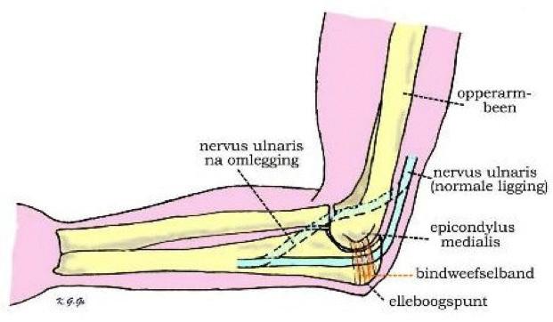 Inleiding U heeft last van een aandoening aan een van de drie armzenuwen (nervus ulnaris of el-leboogzenuw).