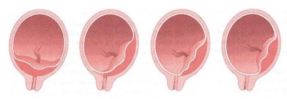 Placenta previa -Placenta previa totalis -Partiele placenta
