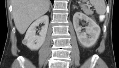 4 Behandeling Bij wie? Tumor kleiner dan 4 cm. (T1a) Beperkt aantal letsels. Nog geen metastasen.