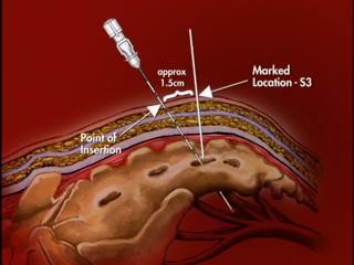 Sacrale neuromodulatie