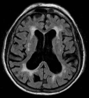 Voor het verslag van deze lezing wordt hier de samenvatting geciteerd van het artikel Diagnostiek van de ziekte van Alzheimer in het tijdschrift Neuropraxis in 2018.