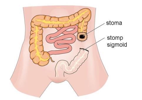 Afbeelding 3: een enkelloops stoma Afbeelding 4: een dubbelloops stoma De ontlasting verlaat het lichaam dan via deze