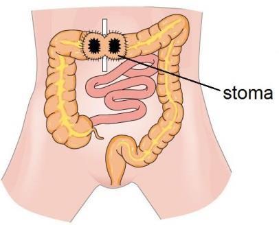 Andere benamingen voor dit stoma zijn colostoma of AP (anus praeternaturalis). Wanneer is een tijdelijk stoma nodig?