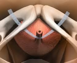 De operatie De ingreep wordt in dagbehandeling verricht door de gynaecoloog met een ruggenprik, slaapmedicatie of onder narcose.