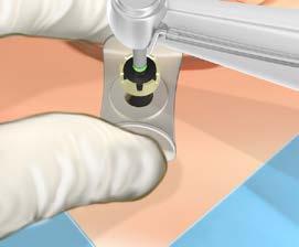 Stap 3: Boren met cannula guide drill Het boren wordt uitgevoerd om de botdikte te meten en de juiste keuze te maken van de lengte van het implantaat. Stel de boorsnelheid in op 1500-2000 rpm. (Fig.