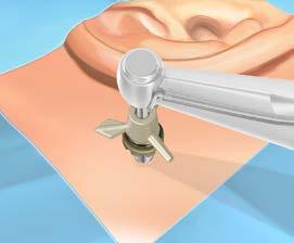 Pak het implantaat met voorgemonteerd abutment op met behulp van de abutment inserter die aan het handstuk is bevestigd. (Fig. 21) Verwijder de cannula uit de chirurgische locatie.