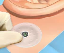 25-26) De healing cap houdt het verband op zijn plaats en minimaliseert het risico op hematomen.