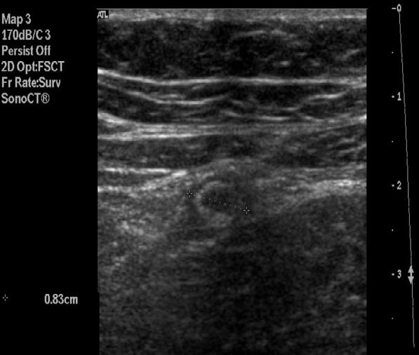 Beeldvorming Echografie Appendix (>0,6 mm), niet comprimeerbaar, verdikte wand, abces, vrij vocht, verminderde peristaltiek,