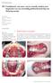 M1 Combinatie van naar voren staande tanden met impacties en een overtallig gebitselement bij een 10-jarig meisje