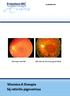 Centrumlocatie. Vitamine A therapie bij retinitis pigmentosa