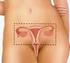 Verwijderen van de baarmoeder via buikwand of via vagina bij goedaardige aandoeningen