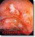 Medicatie bij de ziekte van Crohn of colitis ulcerosa Methotrexaat (MTX) (ledertrexate )