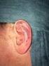 Afstaande oren. Informatie over een correctie van afstaande oren bij kinderen door de plastische chirurg