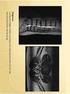 Casus 3: Osteoporotische Indeukingsfractuur JEF MICHIELSEN