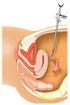 Sterilisatie van de vrouw Sterilisatie overwegen Hysteroscopisch (essure methode) Laparoscopisch