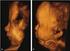 Ultrasonography of the fetal nose, maxilla, mandible and forehead as markers for aneuploidy Vos, Fedia