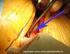 kijkoperatie borstkas of thorascopie
