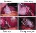 Chirurgie Galblaasverwijdering Cholecystectomie