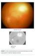 Postnataal verworven oculaire toxoplasmose bij een volwassen vrouw
