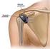 Schouderprothese voor een schouderbreuk. Poli Orthopedie