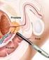Echoscopische biopsie van de prostaat. Weefselonderzoek van de prostaat