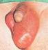Goedaardige zwelling scrotum