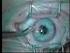 Laserbehandeling van het oog