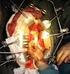 Chirurgie. AAA Endovasculair. Abdominaal Aneurysma van de Aorta