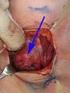 Chirurgie Operatie aan de schildklier Strumectomie