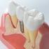 Complicaties en mislukkingen in de dentoalveolaire chirurgie