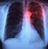 Inhalatiecorticosteroïden bij COPD