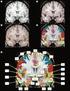 Magnetic resonance imaging studies on neuropsychiatric systemic lupus erythematosus. Stefan Steens