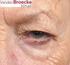 Hangend bovenooglid, Ptosis