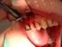 Endodontische herbehandeling of apexresectie: is een evidencebased keuze mogelijk?