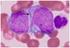 Minimale restziekte en leukemische stamceldetectie bij acute myeloïde leukemie: nieuwe aanpak van klinische besluitvorming