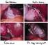 Verwijderen van de galblaas Cholecystectomie