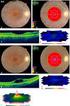 In chapter 9, we studied cgmp expression in pig retinas and pig vitreous fluid after creating an experimental retinal detachment.