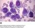 Acute myeloïde leukemie in het tweede en derde trimester van de zwangerschap