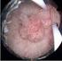 Het verwijderen van een tumor uit de blaas Transurethrale resectie van een tumor (TURT)