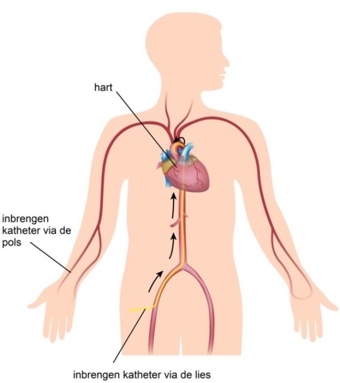 We sluiten u aan op de bewakingsmonitor en we dekken uw lichaam af met een steriel laken. Rechts van u staan de cardioloog en de assistent.