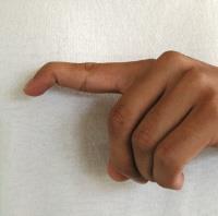 Afbeelding 1: Mallet finger (wijsvinger linker hand). Oorzaken Een mallet finger ontstaat meestal door een directe klap op de top van een gestrekte vinger.