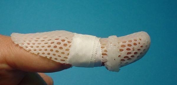 Behandeling Er zijn twee manier om een mallet finger te behandelen: operatief en niet-operatief. Niet-operatieve behandeling: Mallet-spalk Meestal kan een mallet finger met een spalk behandeld worden.