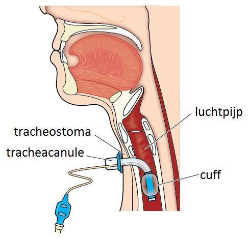 Inleiding De arts heeft u verteld dat uw familielid of naaste een tijdelijke tracheostoma krijgt.