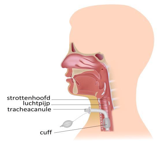 Afbeelding 2: de tracheastoma van buitenaf gezien Het inbrengen van de tracheostoma kan zowel op de operatiekamer als op de Intensive Care plaatsvinden.