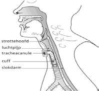 tracheacanule, de eerste paar dagen, irriteren of pijnlijk aanvoelen in de hals.door de ingreep ontstaat een wondje, dat regelmatig verzorgd wordt.