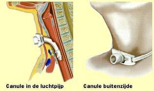 Tracheostoma U, uw familielid of naaste krijgt binnenkort een tracheostoma of heeft al een tracheostoma. Op de afdeling heeft u hier informatie over gekregen.