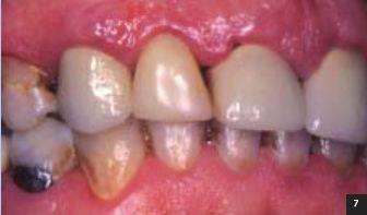 Op een later tijdstip zou dan de endodontische behandeling kunnen worden afgemaakt en een stiftopbouw en kroon kunnen worden gemaakt.
