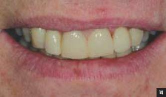 Casus 4 Enkele jaren geleden is bij een 50-jarige tandarts een tweede molaar endodontisch behandeld.