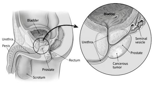 HOOFDSTUK 1 WAT IS LOKAAL BEPERKTE? HOOFDSTUK 2 WELKE BEHANDELOPTIES ZIJN ER? Prostaatkanker is kanker van de prostaat. Lokaal beperkt betekent dat de tumor alleen in de prostaat zit.