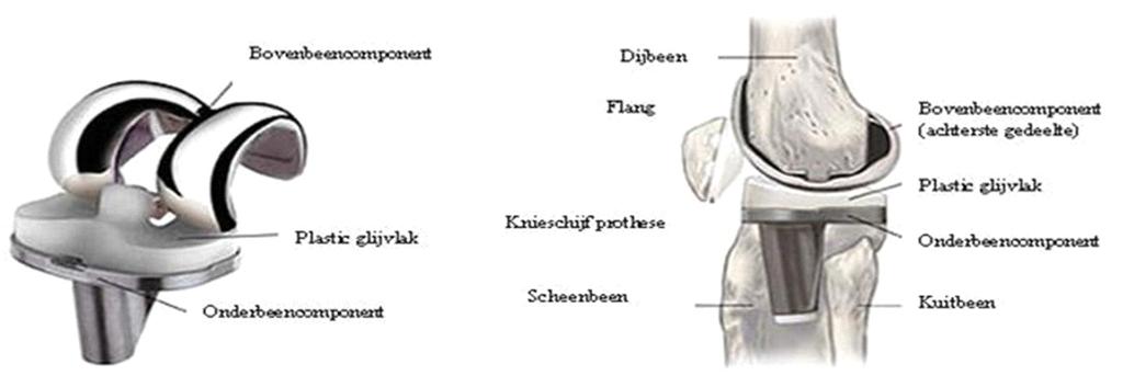 Waarom een knieprothese? Slijtage van het kraakbeen is de meest voorkomende reden voor de operatie. De gewrichtsvlakken bewegen niet meer soepel langs elkaar.